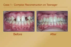 Dental Crowns: The Perfect Solution for Restoring Damaged Teeth